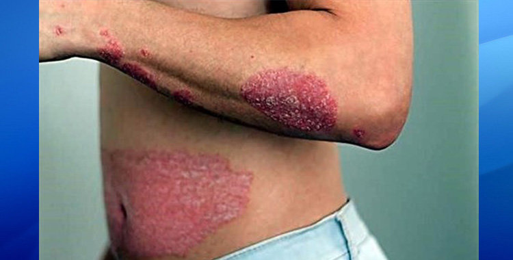 PSORIASIS, AFECCIÓN QUE TRASCIENDE LA PIEL