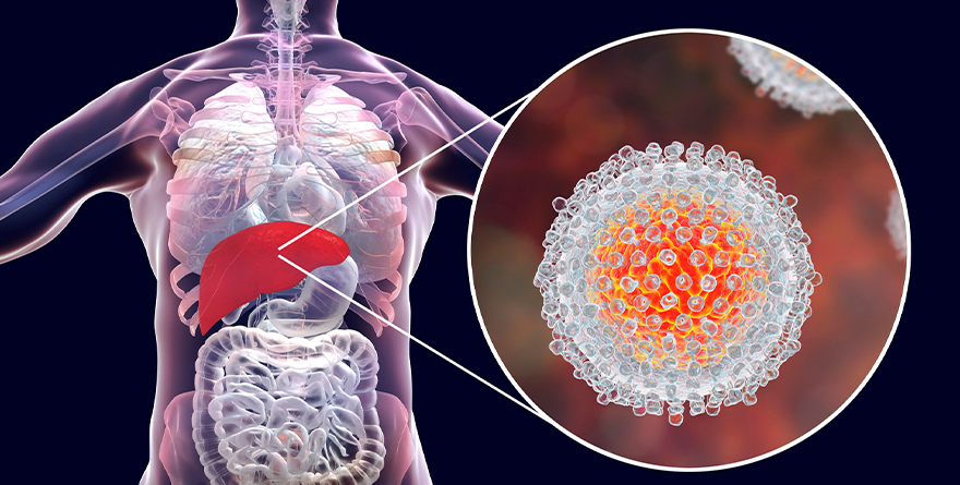 RECOMIENDA IDENTIFICAR SINTOMATOLOGÍA POR HEPATITIS C