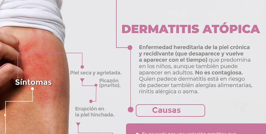 INFORMAN SOBRE SÍNTOMAS DE DERMATITIS ATÓPICA