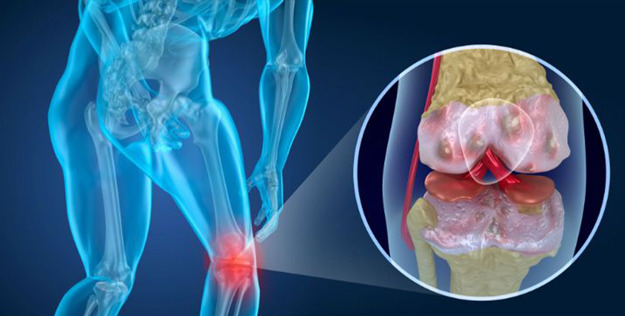 MEDIDAS DE PREVENCIÓN DE ARTROSIS ARTICULAR EN ADULTOS MAYORES