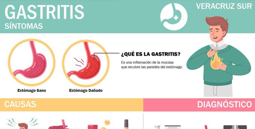 EXPLICAN SOBRE SÍNTOMAS DE GASTRITIS