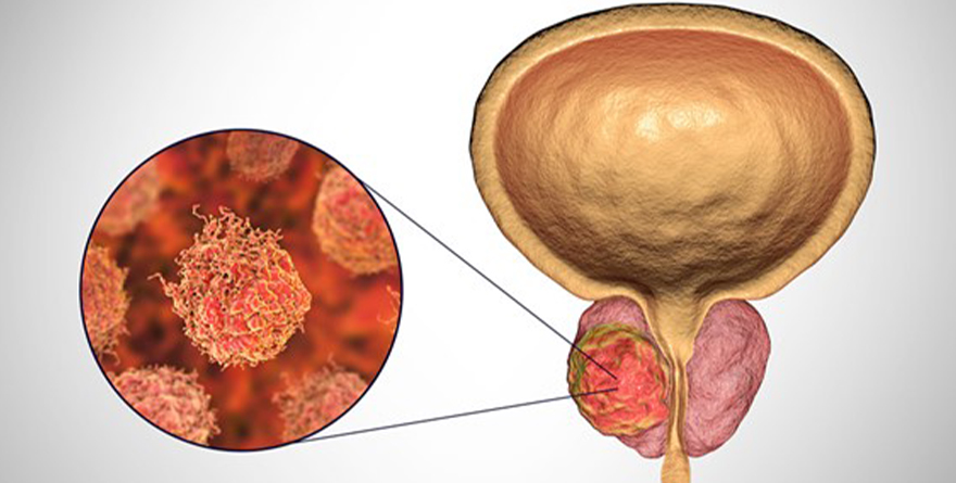 VIGENTE, EL PREJUICIO MACHISTA PARA DETECTAR EL CÁNCER DE PRÓSTATA