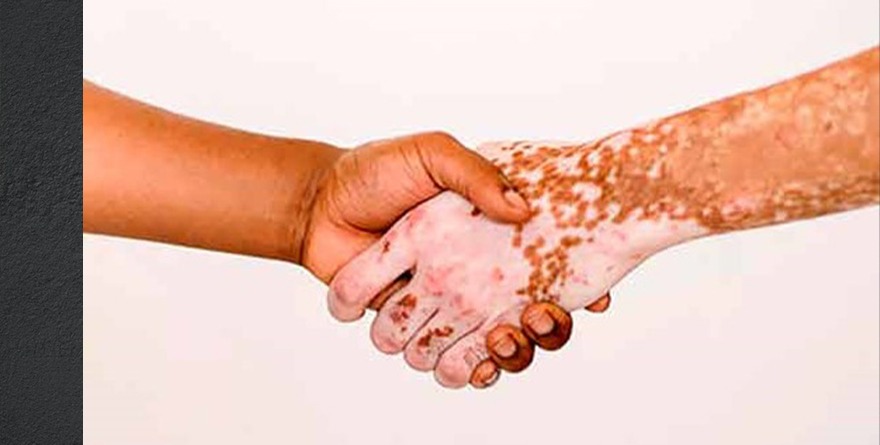 ENTRE 2 Y 6 POR CIENTO DE LOS MEXICANOS PADECE VITILIGO